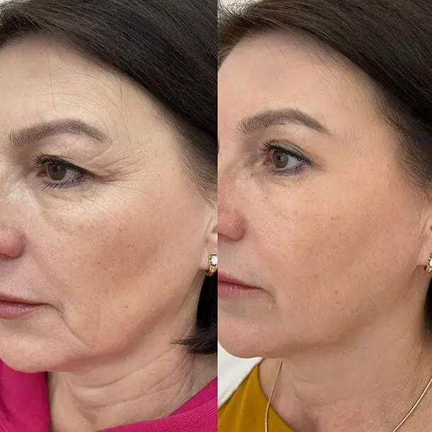 Client Result Kirei Method